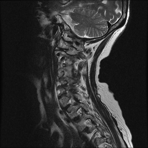 File:Anterior spinal artery syndrome (Radiopaedia 46335-50750 A 8).png