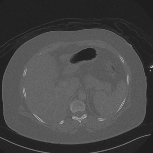 File:Anterior superior iliac spine avulsion fracture (Radiopaedia 44541-48244 Axial bone window 24).png