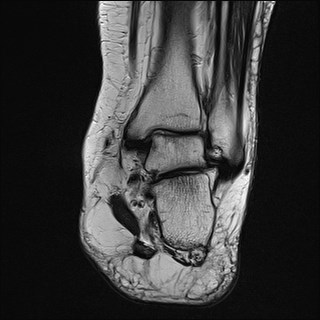File:Anterior talofibular ligament injury - rupture with soft-tissue impingement (Radiopaedia 38765-40928 Coronal T2 13).jpg