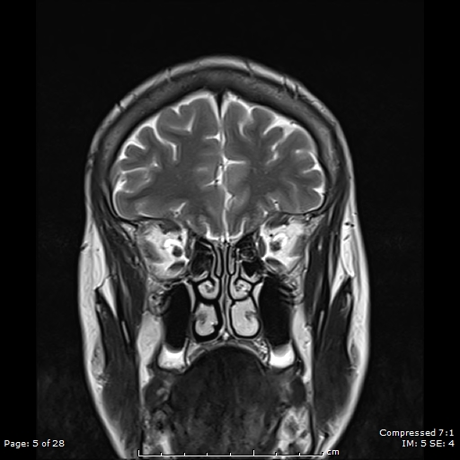 File:Anterior temporal lobe perivascular space (Radiopaedia 88283-104914 Coronal T2 5).jpg