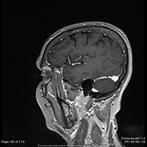 File:Anterior temporal lobe perivascular space (Radiopaedia 88283-104914 Sagittal T1 C+ 6).jpg