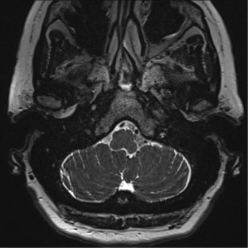 Anterior temporal pole cysts (Radiopaedia 46629-51102 Axial T2 11).png