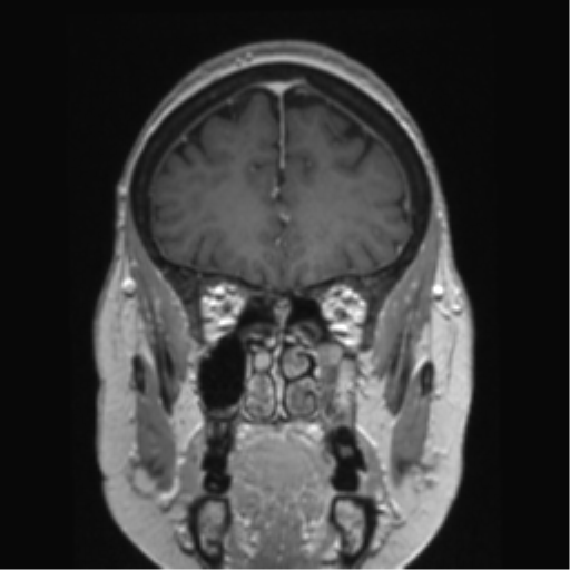 Anterior temporal pole cysts (Radiopaedia 46629-51102 Coronal T1 C+ 131).png