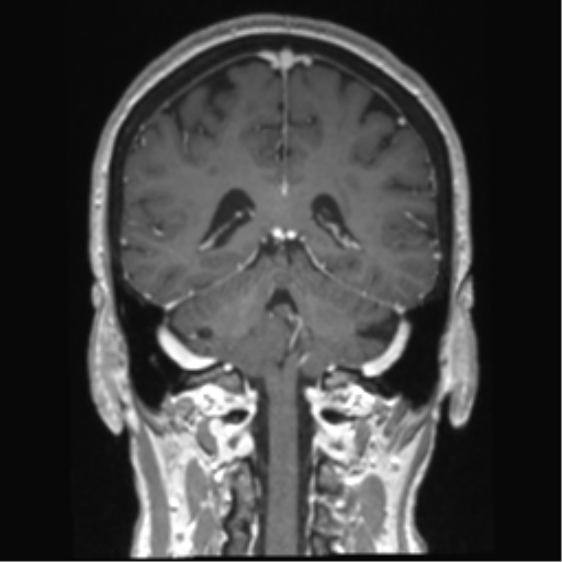Anterior temporal pole cysts (Radiopaedia 46629-51102 Coronal T1 C+ 62).png