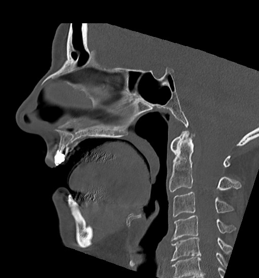 Anterior temporomandibular joint dislocation (Radiopaedia 59430-66784 B 32).jpg