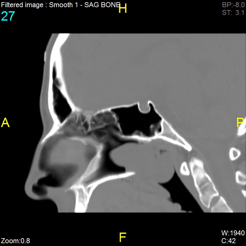 Antrochoanal polyp (Radiopaedia 65101-74094 Sagittal bone window 27).jpg
