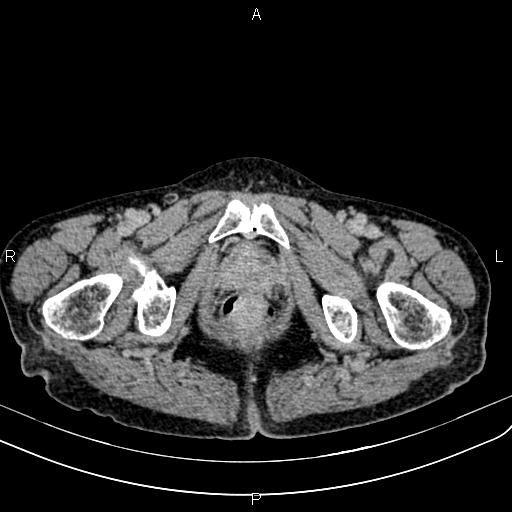 Aortic aneurysm and Lemmel syndrome (Radiopaedia 86499-102554 Axial C+ delayed 81).jpg