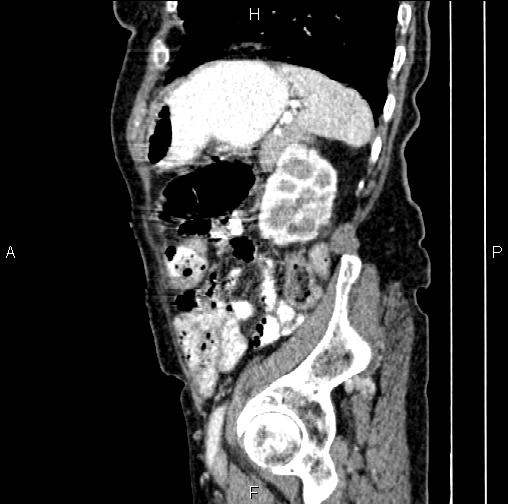 Aortic aneurysm and Lemmel syndrome (Radiopaedia 86499-102554 D 70).jpg