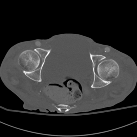Aortic aneurysm with spinal destruction (Radiopaedia 42301-45410 Axial bone window 104).jpg