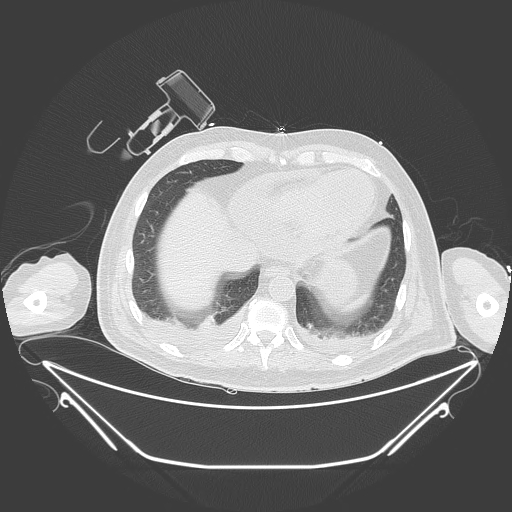 Aortic arch aneurysm (Radiopaedia 84109-99365 Axial lung window 220).jpg