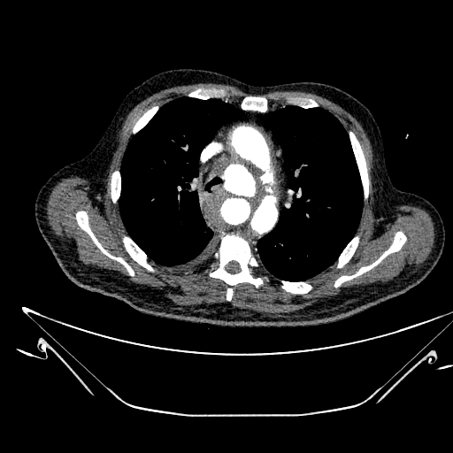 Aortic arch aneurysm (Radiopaedia 84109-99365 B 234).jpg