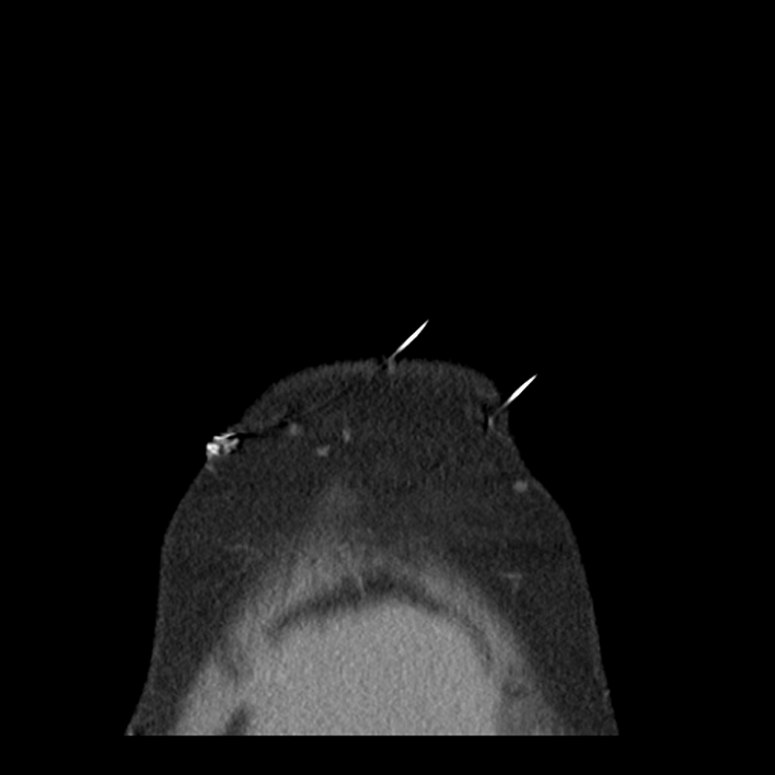Aortic arch graft infection (FDG PET-CT) (Radiopaedia 71975-82437 Coronal 4).jpg