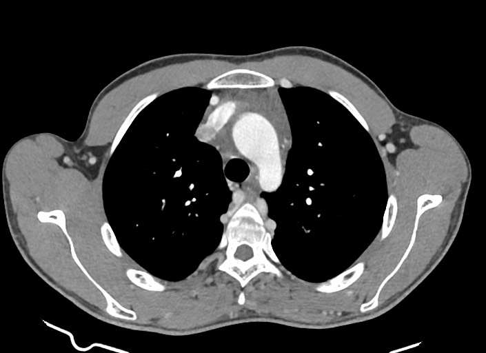 File:Aortic coarctation with aneurysm (Radiopaedia 74818-85828 A 148).jpg