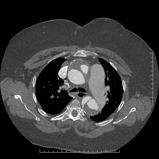 Aortic dissection- Stanford A (Radiopaedia 35729-37268 A 27).jpg
