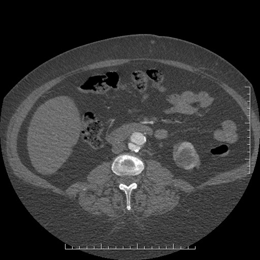 File:Aortic dissection- Stanford A (Radiopaedia 35729-37268 C 17).jpg