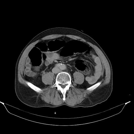 File:Aortic dissection- Stanford type A (Radiopaedia 22085-22085 Axial C+ delayed 33).jpg
