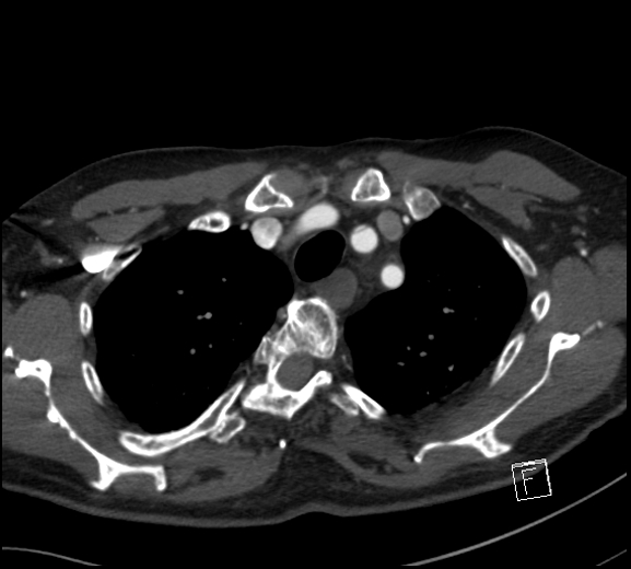 Aortic dissection (CTPA) (Radiopaedia 75506-86750 A 19).jpg