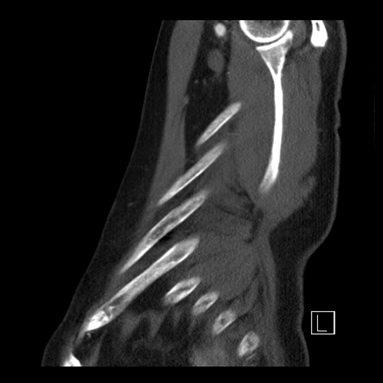 File:Aortic dissection (CTPA) (Radiopaedia 75506-86750 C 97).jpg