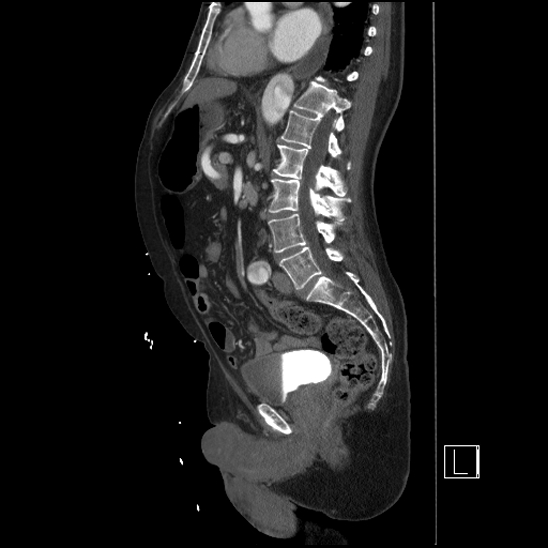 Aortic dissection (CTPA) (Radiopaedia 75506-86750 G 57).jpg