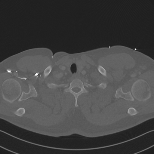 File:Aortic dissection (Radiopaedia 50763-56234 Axial bone window 12).png