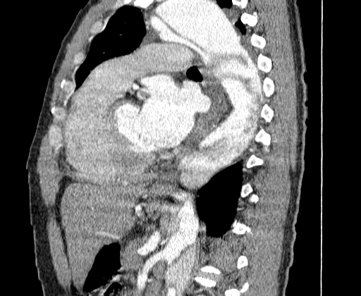 Aortic dissection - Stanford A -DeBakey I (Radiopaedia 28339-28587 C 46).jpg