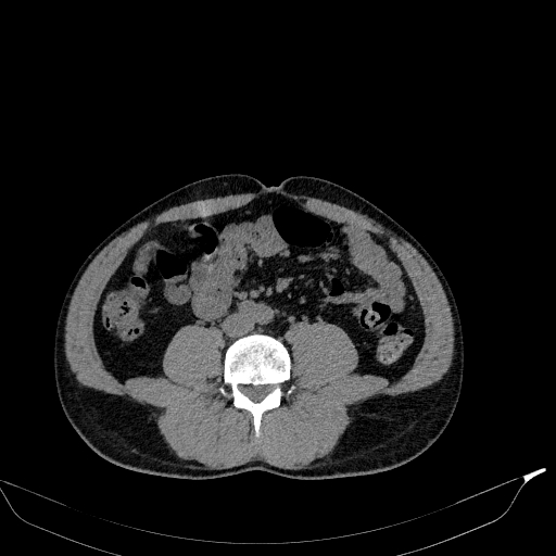 File:Aortic dissection - Stanford type A (Radiopaedia 83418-98500 Axial non-contrast 64).jpg