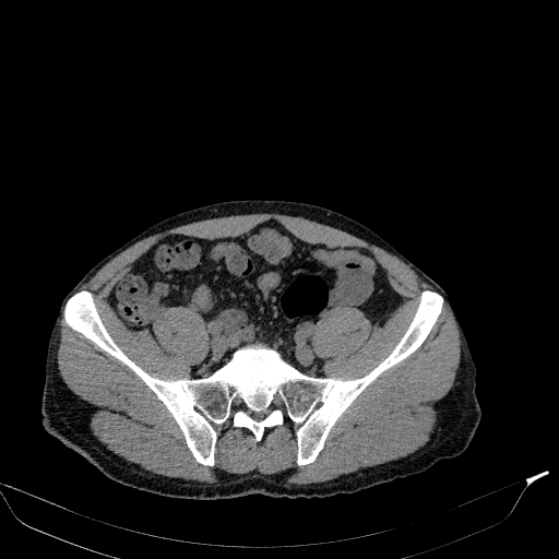 Aortic dissection - Stanford type A (Radiopaedia 83418-98500 Axial non-contrast 75).jpg