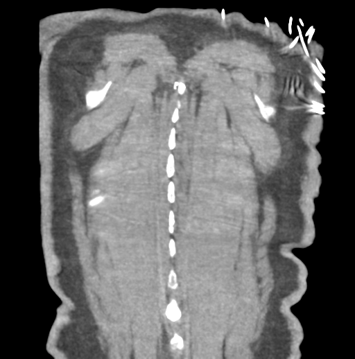 Aortic dissection - Stanford type B (Radiopaedia 50171-55512 B 80).png
