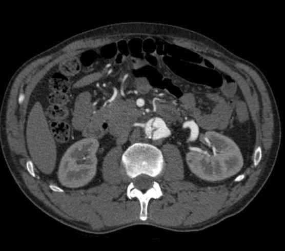 Aortic dissection - Stanford type B (Radiopaedia 73648-84437 A 149).jpg