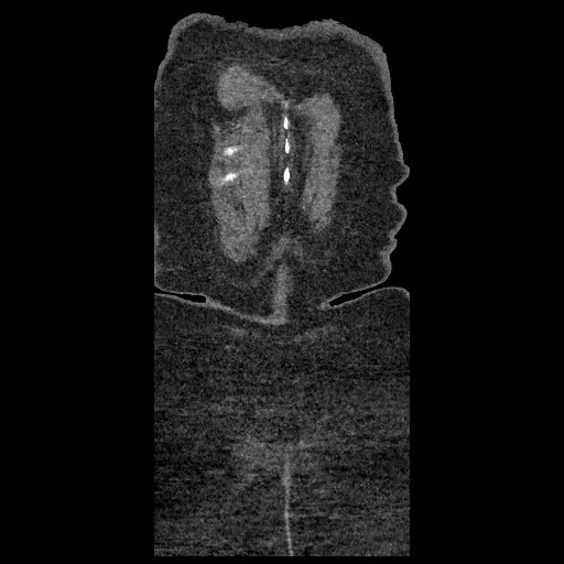 File:Aortic dissection - Stanford type B (Radiopaedia 88281-104910 B 93).jpg