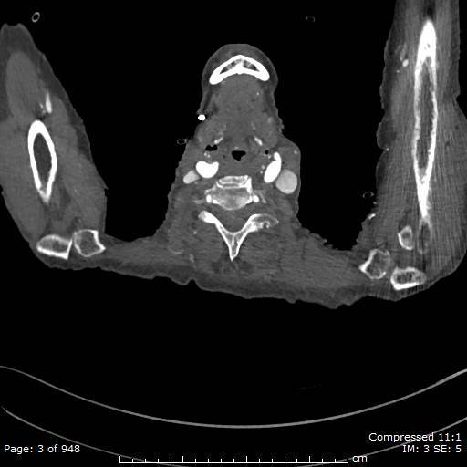 File:Aortic dissection with extension into aortic arch branches (Radiopaedia 64402-73204 B 3).jpg