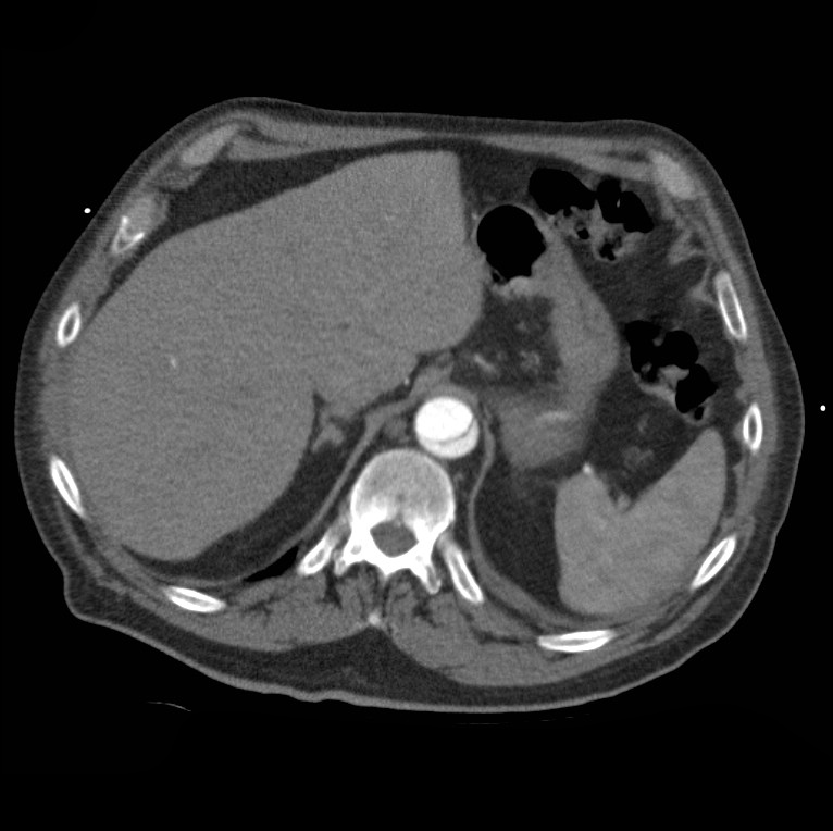Aortic dissection with rupture into pericardium (Radiopaedia 12384-12647 A 51).jpg