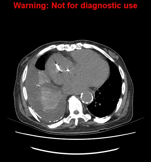 File:Aortic graft infection (Radiopaedia 44979-48907 Axial non-contrast 10).jpg