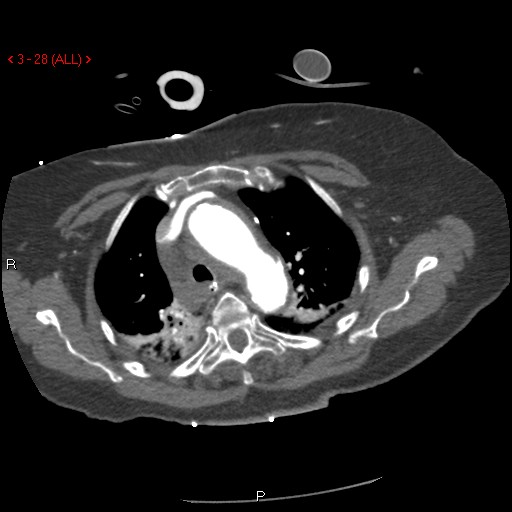 Aortic intramural hematoma (Radiopaedia 27746-28001 A 28).jpg