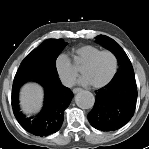 File:Aortic intramural hematoma (Radiopaedia 31139-31838 Axial non-contrast 38).jpg
