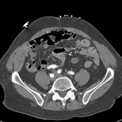 Aortic intramural hematoma (Radiopaedia 31139-31838 B 129).jpg