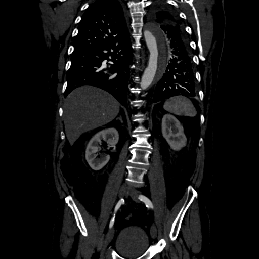 Aortic intramural hematoma (Radiopaedia 34260-35540 C 58).png