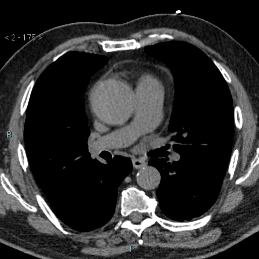 Aortic intramural hematoma (Radiopaedia 48463-53380 Axial non-contrast 77).jpg