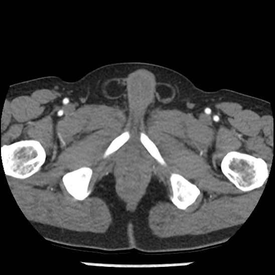 File:Aortic intramural hematoma (type B) (Radiopaedia 79323-92387 B 121).jpg