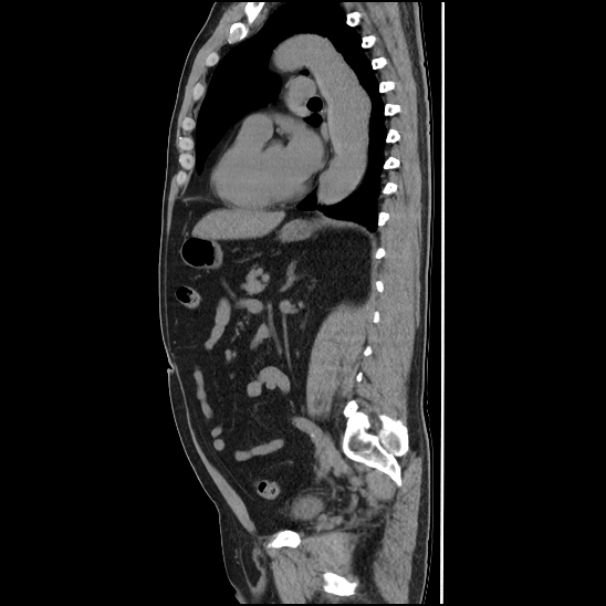 Aortic intramural hematoma (type B) (Radiopaedia 79323-92387 G 32).jpg