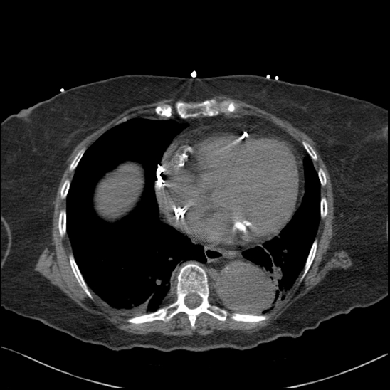 Aortic intramural hematoma with dissection and intramural blood pool (Radiopaedia 77373-89491 Axial non-contrast 65).jpg