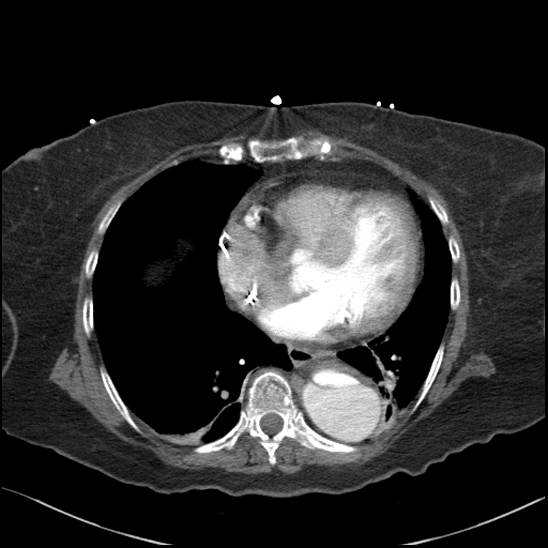 File:Aortic intramural hematoma with dissection and intramural blood pool (Radiopaedia 77373-89491 B 76).jpg
