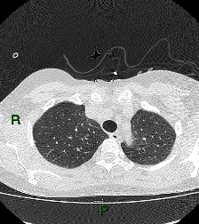 File:Aortic valve endocarditis (Radiopaedia 87209-103485 Axial lung window 24).jpg