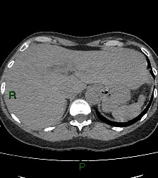 Aortic valve endocarditis (Radiopaedia 87209-103485 Axial non-contrast 89).jpg