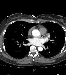 File:Aortic valve endocarditis (Radiopaedia 87209-103485 C 51).jpg