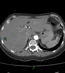 File:Aortic valve endocarditis (Radiopaedia 87209-103485 C 92).jpg