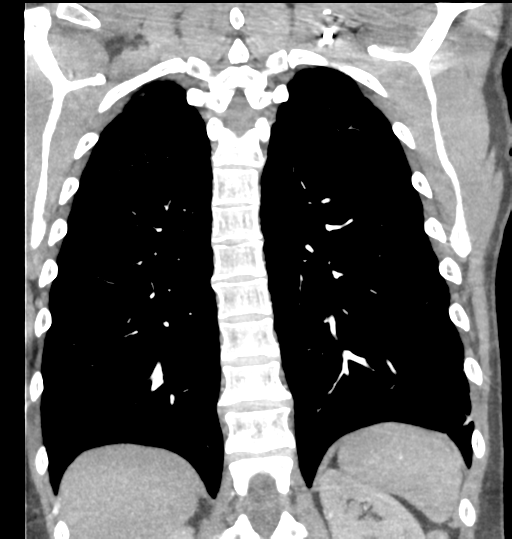File:Aortic valve non-coronary cusp thrombus (Radiopaedia 55661-62189 C 59).png