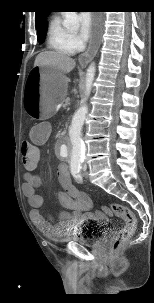 Aortoduodenal fistula (Radiopaedia 75286-86415 Sagittal C+ delayed 33).jpg