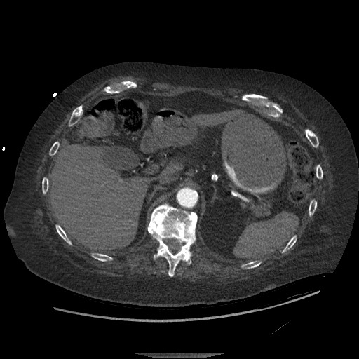 Aortoesophageal fistula with endovascular repair (Radiopaedia 73781-84592 Axial C+ CTPA 178).jpg