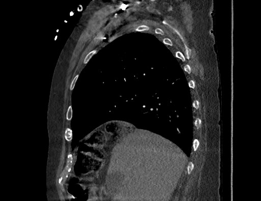 Aortoesophageal fistula with endovascular repair (Radiopaedia 73781-84592 Sagittal C+ CTPA 47).jpg